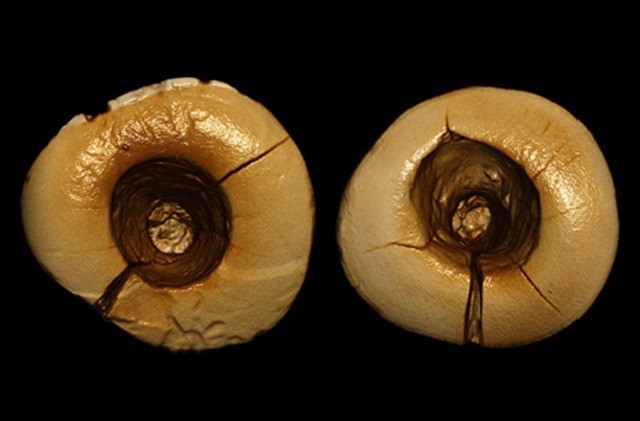 dentisterie-neolithique