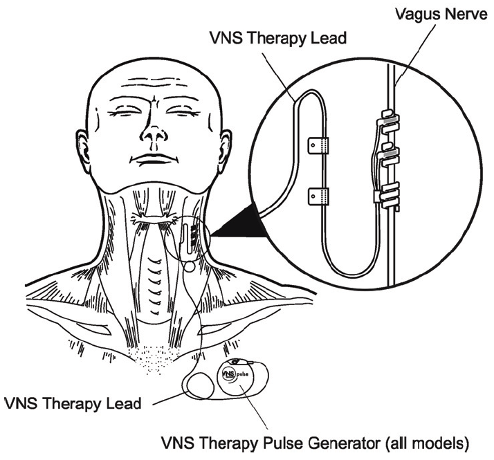 VNS-thalamus