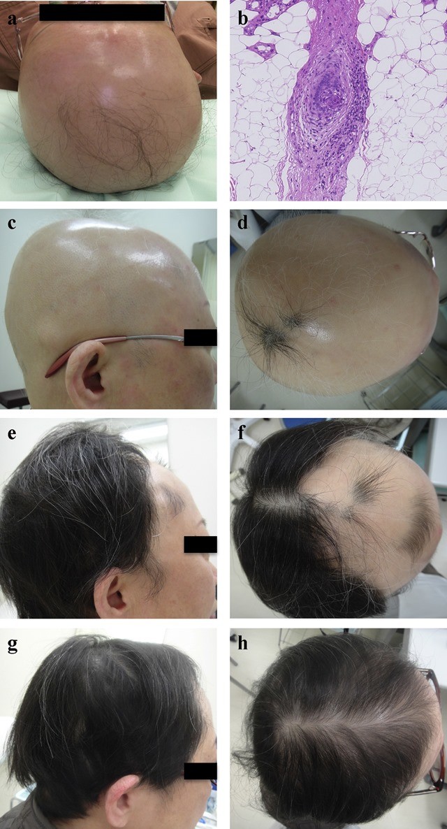 Successful treatment of refractory alopecia universalis by persuading a patient not to sleep with her dog 再投稿
