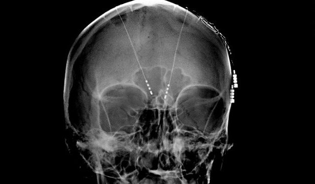 deep-brain-stimulation-x-ray-18