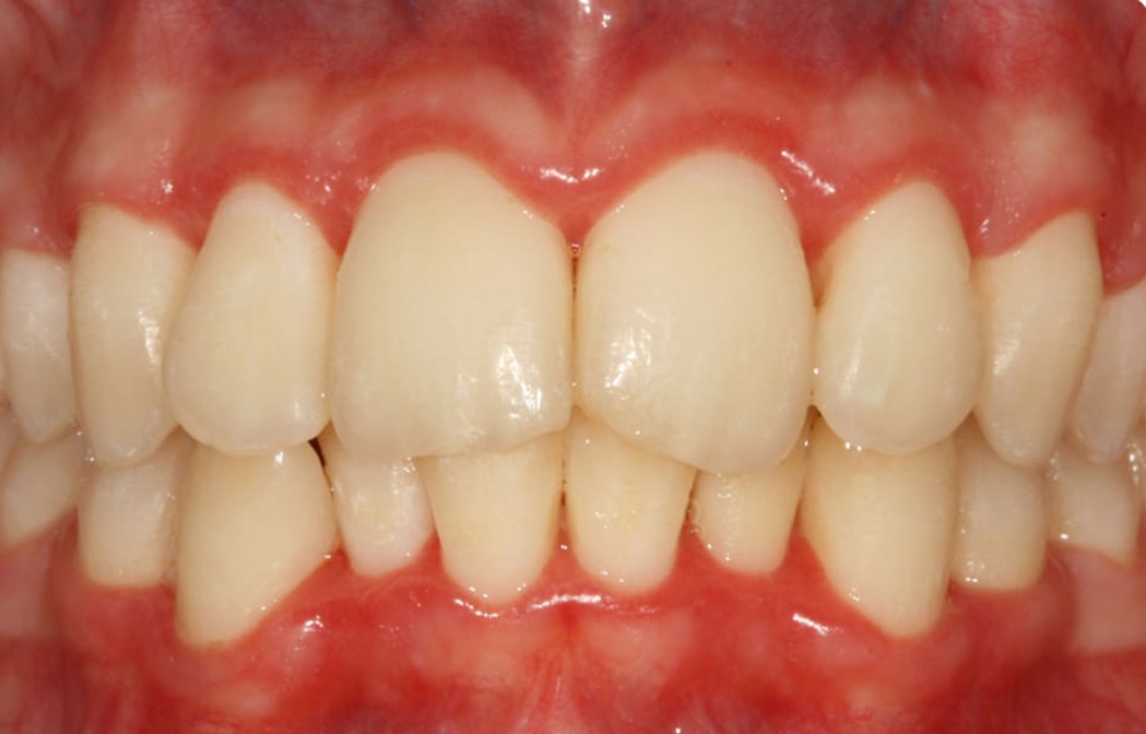parodontite 19
