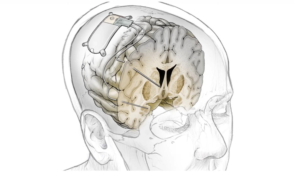 implant cérébral dépressiion Sarha 2 21