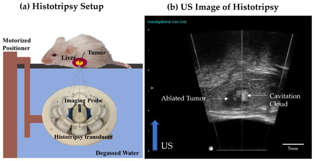 Cancer ultrason histotripsie 3 22
